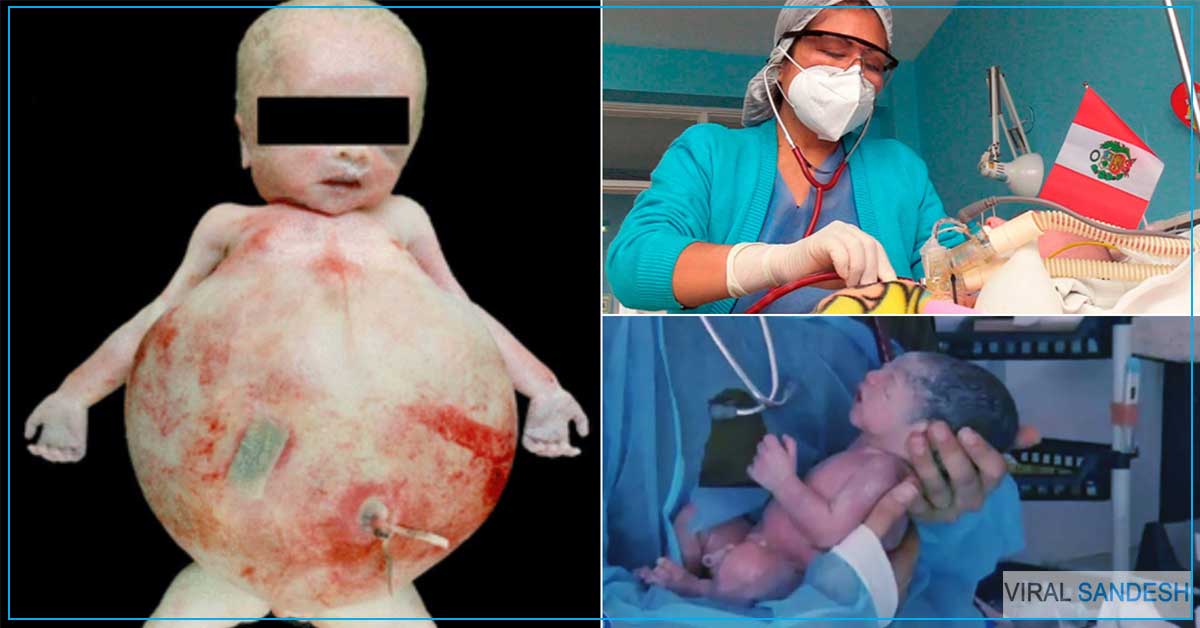 fetus in fetu parasitic twin israel